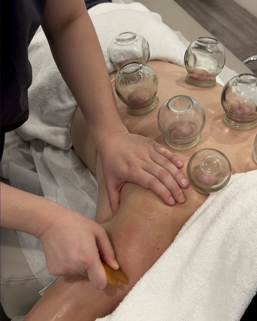 Fire cupping and gua sha applied across the back during an integrative session